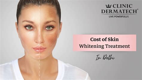 Whitening Treatments .